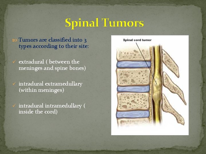 Spinal Tumors are classified into 3 types according to their site: ü extradural (