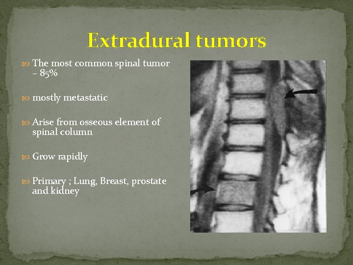 Extradural tumors The most common spinal tumor – 85% mostly metastatic Arise from osseous