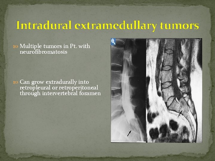 Intradural extramedullary tumors Multiple tumors in Pt. with neurofibromatosis Can grow extradurally into retropleural