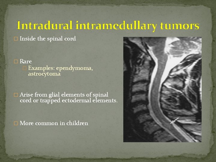 Intradural intramedullary tumors � Inside the spinal cord � Rare � Examples: ependymoma, astrocytoma