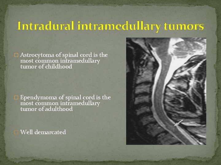 Intradural intramedullary tumors � Astrocytoma of spinal cord is the most common intramedullary tumor