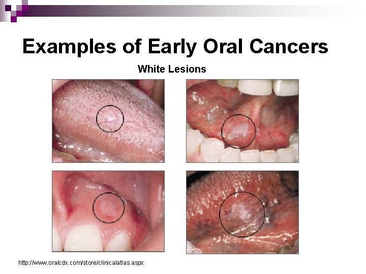 Human papillomavirus mouth and throat cancer - Reacția corpului la tratarea viermilor