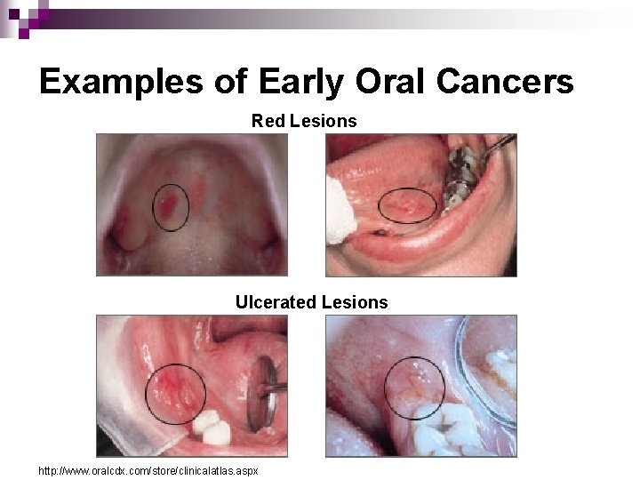 Examples of Early Oral Cancers Red Lesions Ulcerated Lesions http: //www. oralcdx. com/store/clinicalatlas. aspx