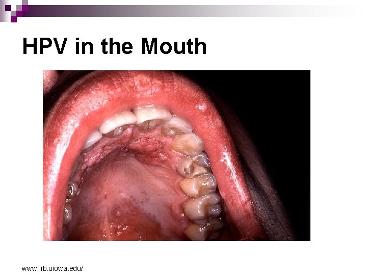 HPV in the Mouth www. lib. uiowa. edu/ 