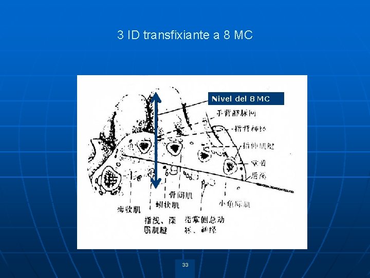 3 ID transfixiante a 8 MC Nivel del 8 MC 33 