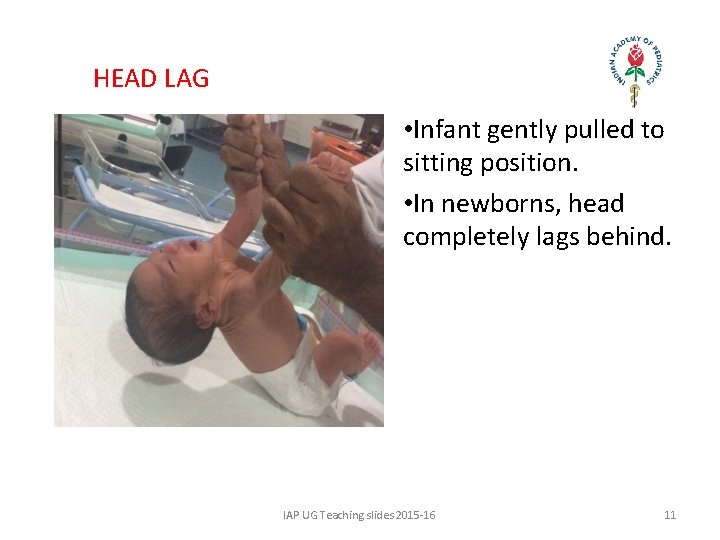 HEAD LAG • Infant gently pulled to sitting position. • In newborns, head completely