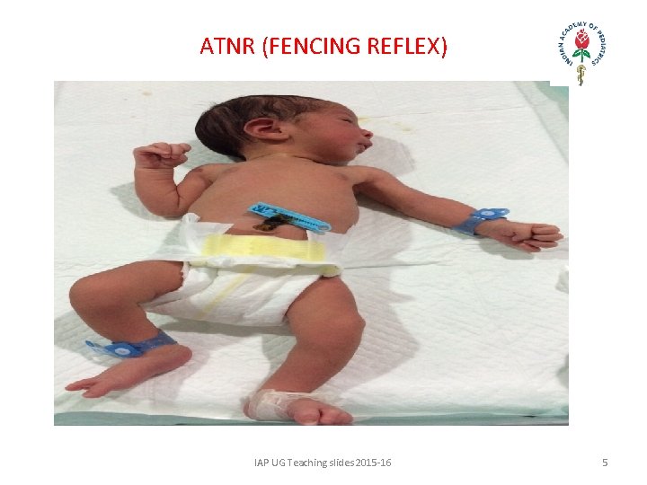 ATNR (FENCING REFLEX) IAP UG Teaching slides 2015 -16 5 