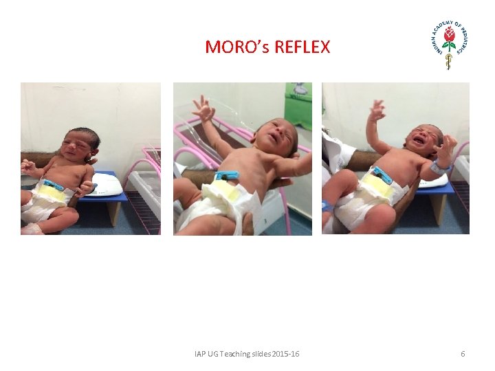 MORO’s REFLEX IAP UG Teaching slides 2015 -16 6 