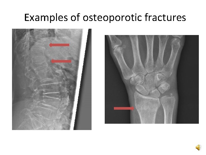 Examples of osteoporotic fractures 