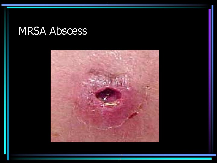 MRSA Abscess 