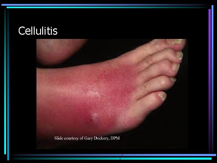 Cellulitis 