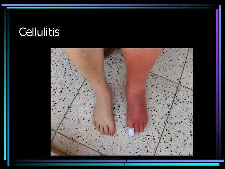 Cellulitis 