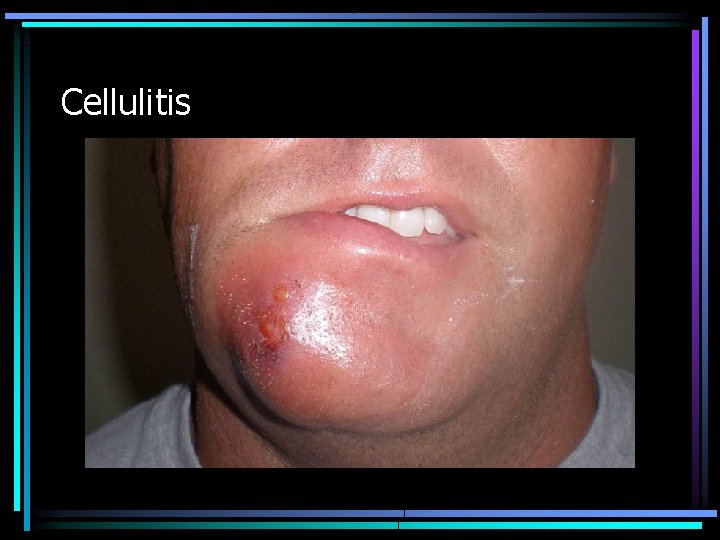 Cellulitis 