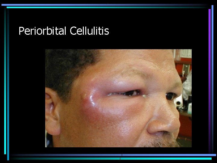 Periorbital Cellulitis 