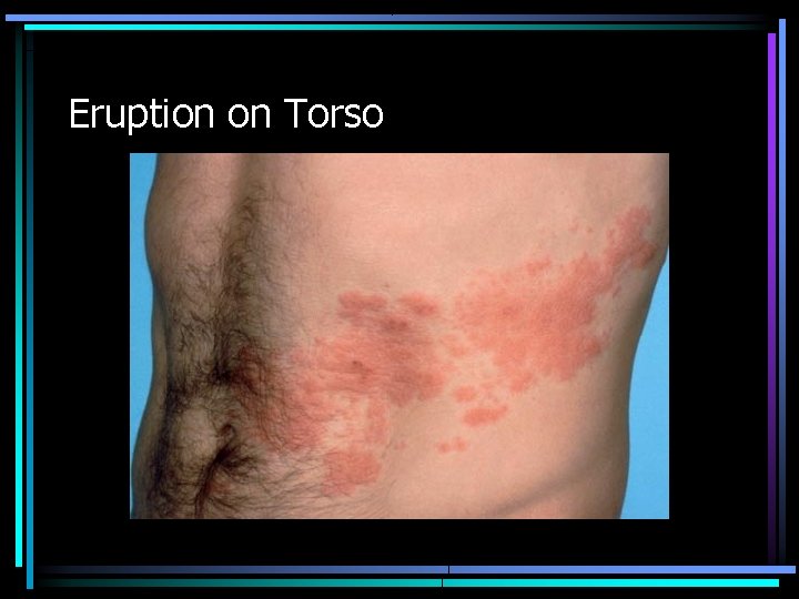 Eruption on Torso 