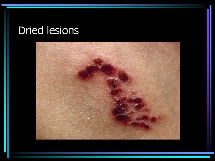 Dried lesions 
