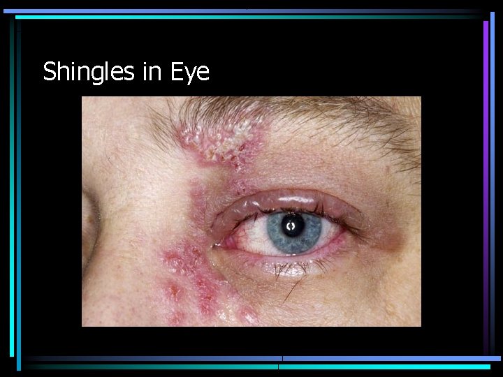 Shingles in Eye 