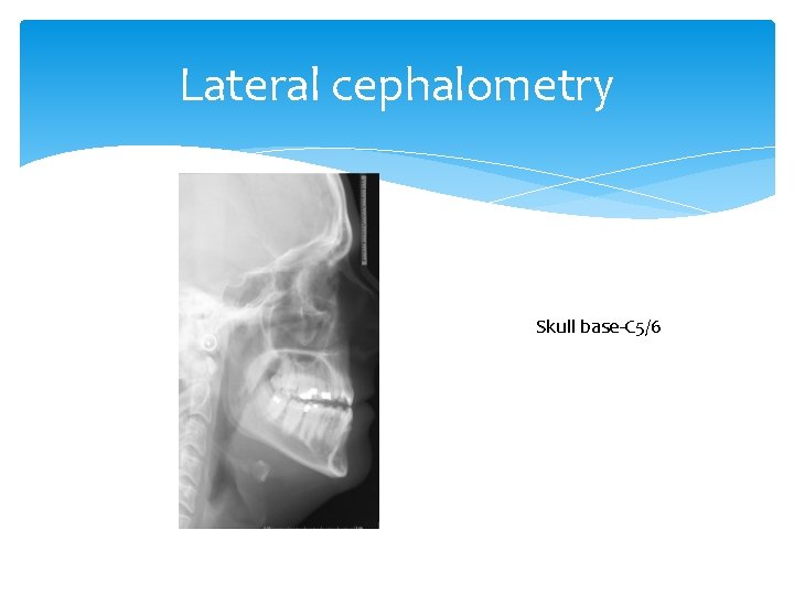 Lateral cephalometry Skull base-C 5/6 