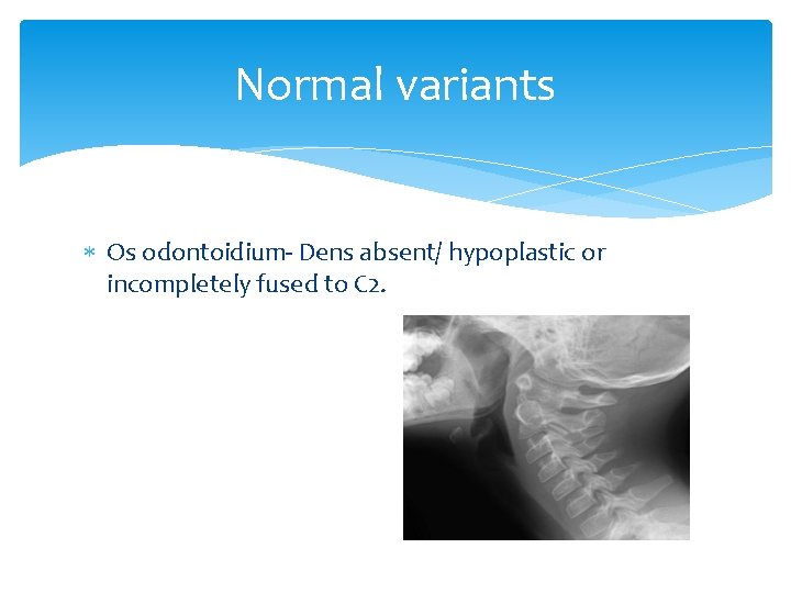 Normal variants Os odontoidium- Dens absent/ hypoplastic or incompletely fused to C 2. 