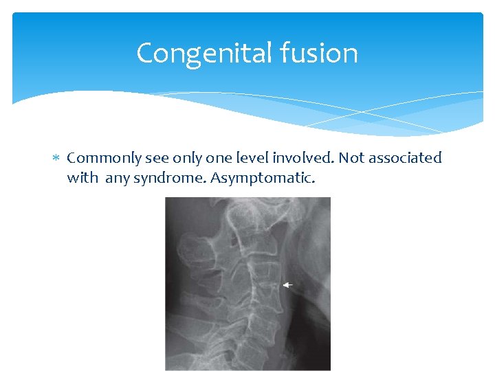 Congenital fusion Commonly see only one level involved. Not associated with any syndrome. Asymptomatic.