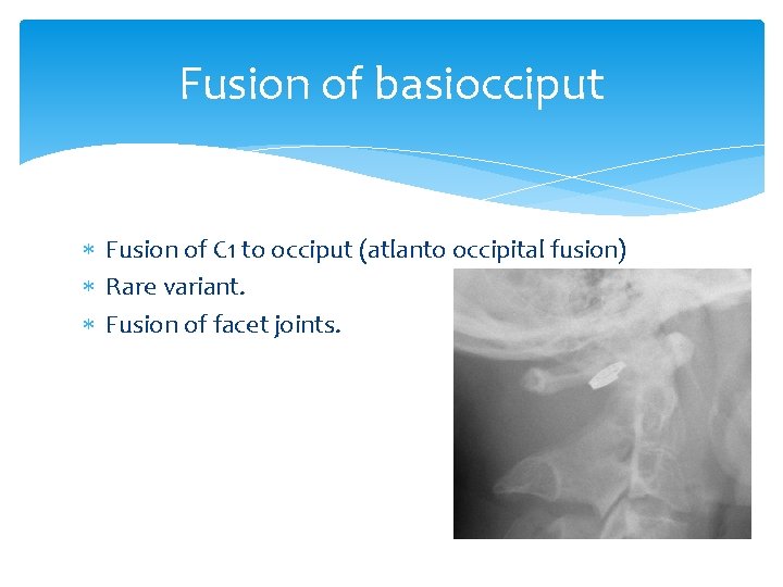 Fusion of basiocciput Fusion of C 1 to occiput (atlanto occipital fusion) Rare variant.