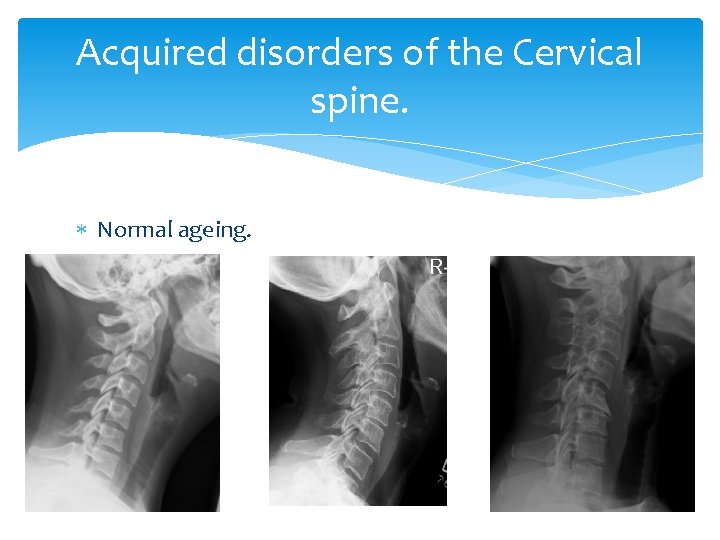 Acquired disorders of the Cervical spine. Normal ageing. . 