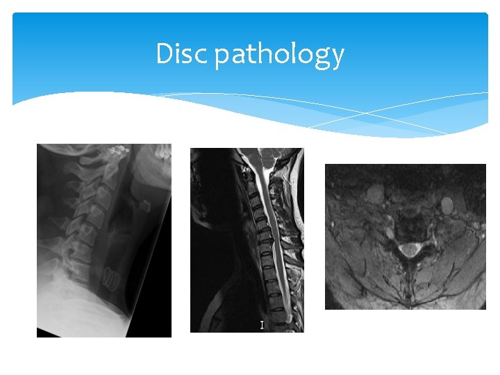 Disc pathology 