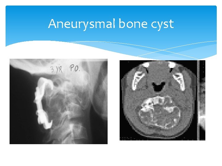 Aneurysmal bone cyst 