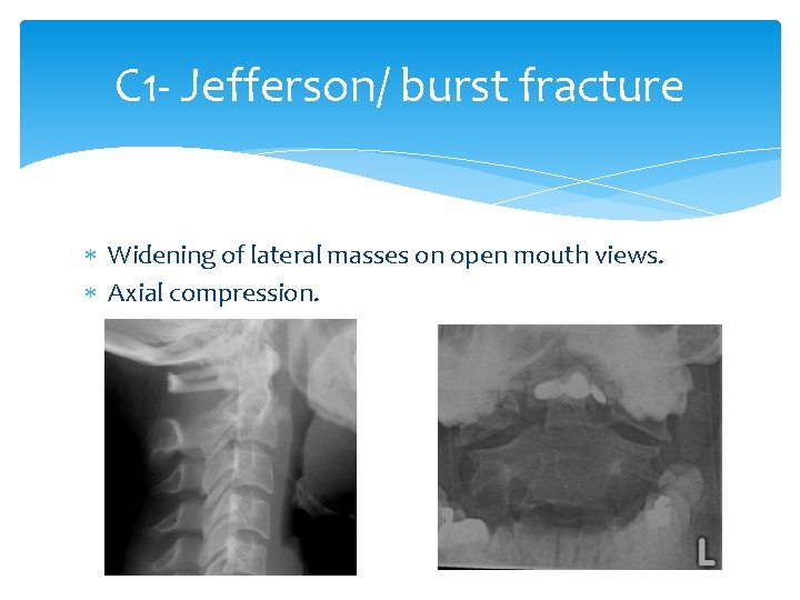 C 1 - Jefferson/ burst fracture Widening of lateral masses on open mouth views.