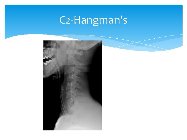 C 2 -Hangman’s 