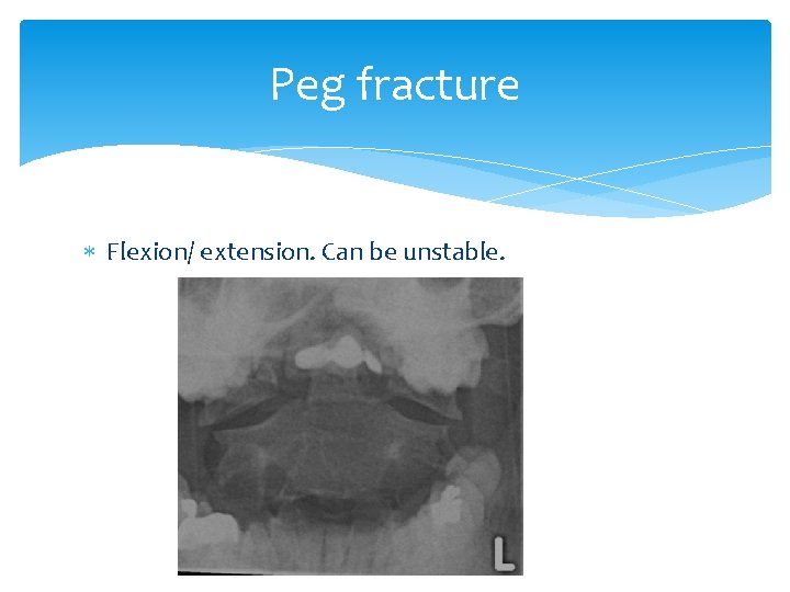 Peg fracture Flexion/ extension. Can be unstable. 