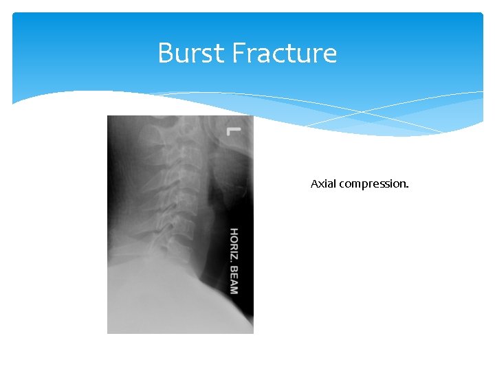 Burst Fracture Axial compression. 