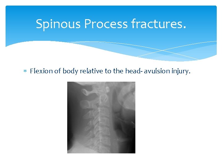 Spinous Process fractures. Flexion of body relative to the head- avulsion injury. 