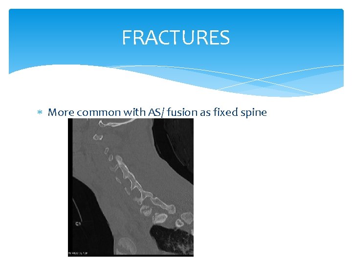FRACTURES More common with AS/ fusion as fixed spine 