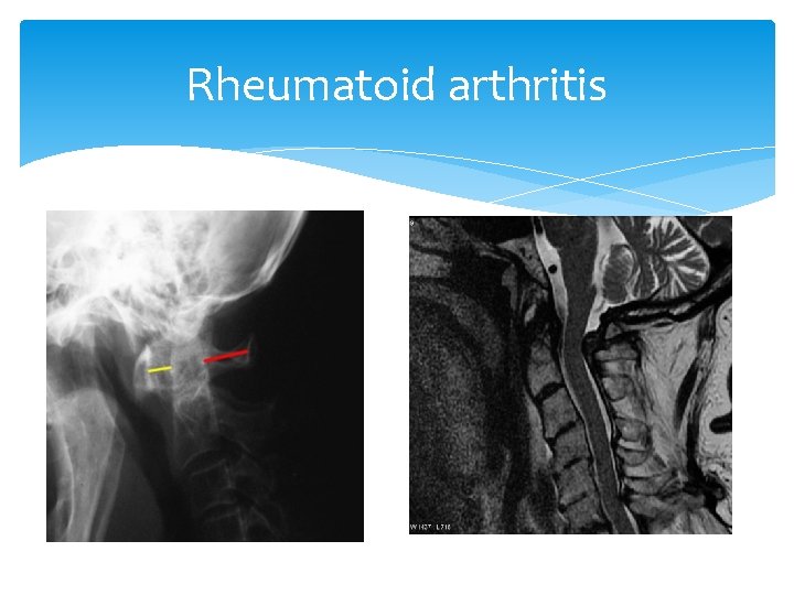 Rheumatoid arthritis 
