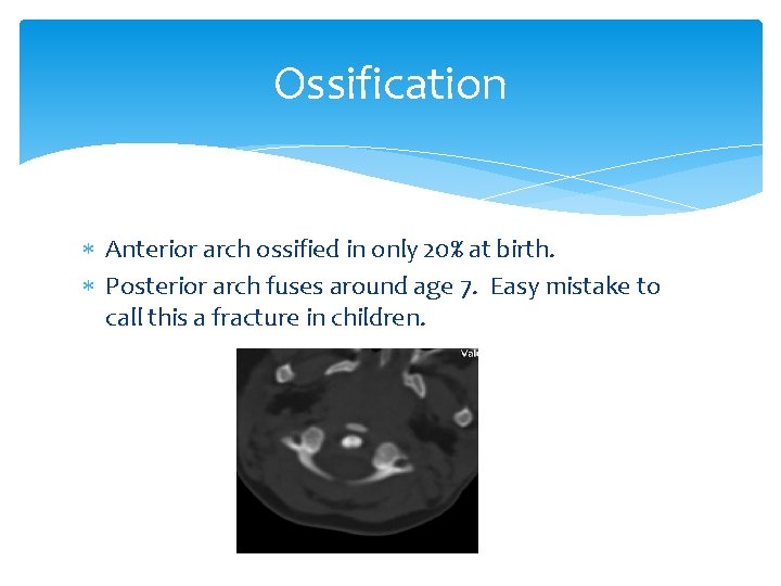 Ossification Anterior arch ossified in only 20% at birth. Posterior arch fuses around age