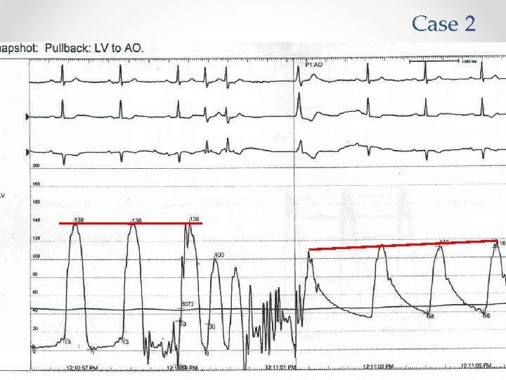 Case 2 70 M presented with shortness of breath Cath findings: • Normal coronary