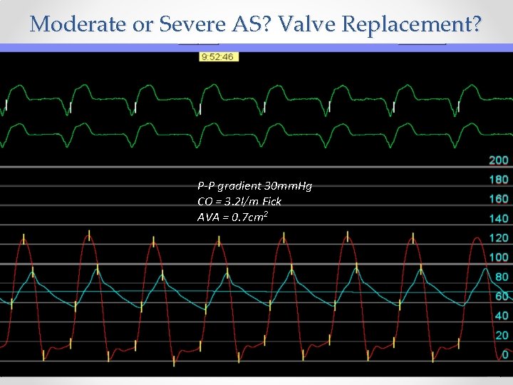 Moderate or Severe AS? Valve Replacement? P-P gradient 30 mm. Hg CO = 3.