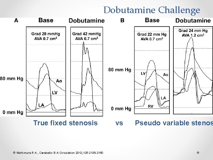 Dobutamine Challenge True fixed stenosis Nishimura R A , Carabello B A Circulation 2012;