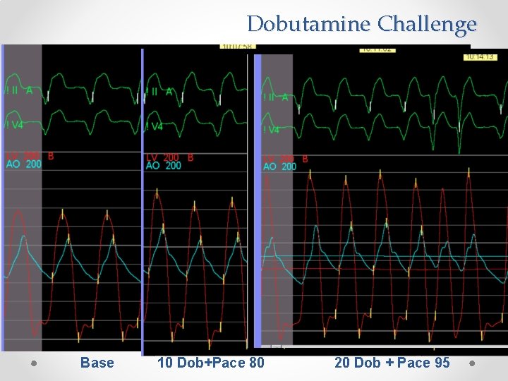 Dobutamine Challenge Base 10 Dob+Pace 80 20 Dob + Pace 95 