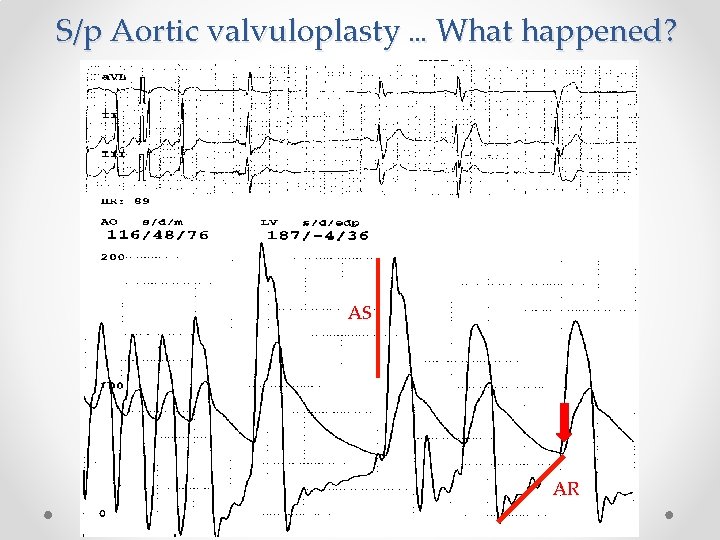 S/p Aortic valvuloplasty … What happened? AS AR 