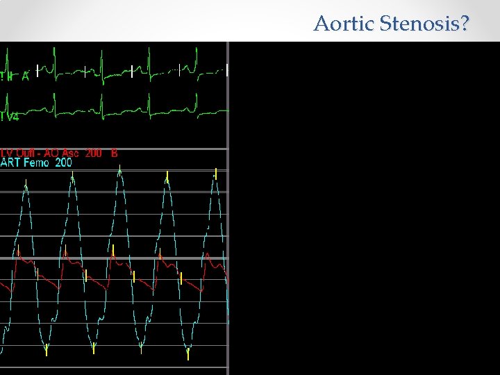 Aortic Stenosis? 