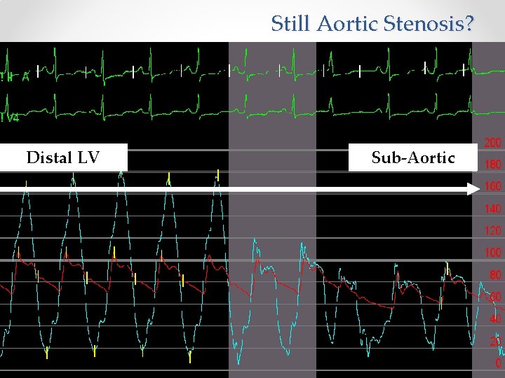 Still Aortic Stenosis? Distal LV Sub-Aortic 