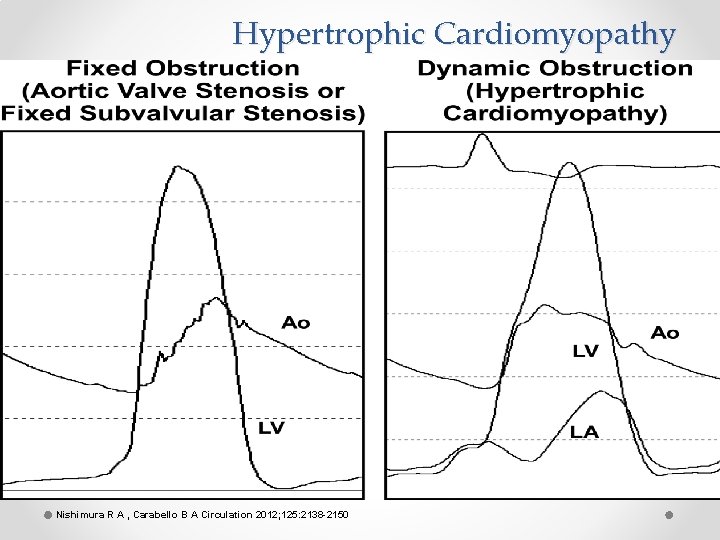 Hypertrophic Cardiomyopathy Nishimura R A , Carabello B A Circulation 2012; 125: 2138 -2150