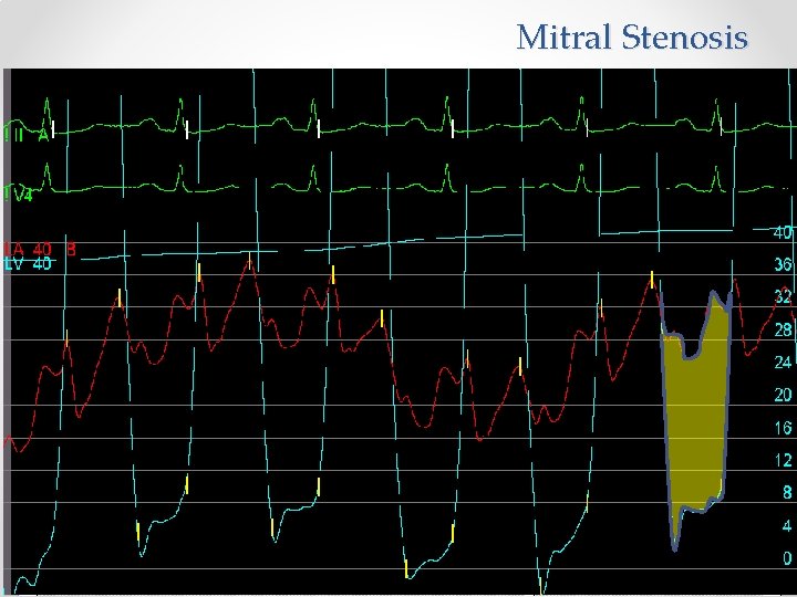 Mitral Stenosis 