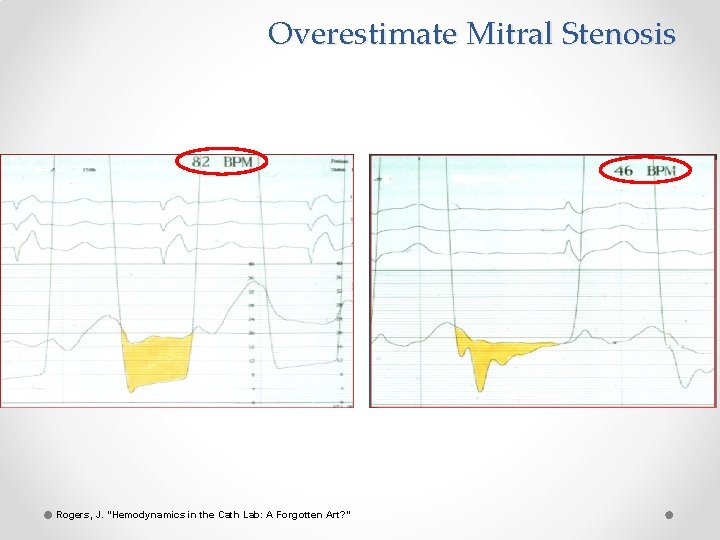 Overestimate Mitral Stenosis Rogers, J. “Hemodynamics in the Cath Lab: A Forgotten Art? ”