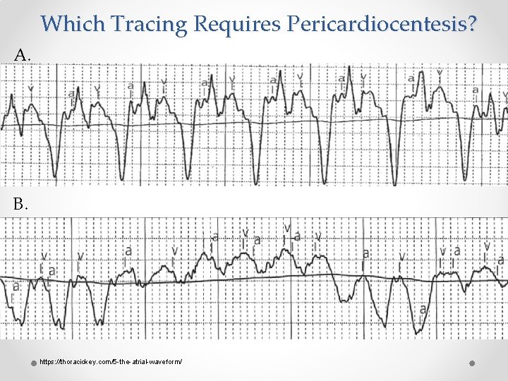 Which Tracing Requires Pericardiocentesis? A. B. https: //thoracickey. com/5 -the-atrial-waveform/ 