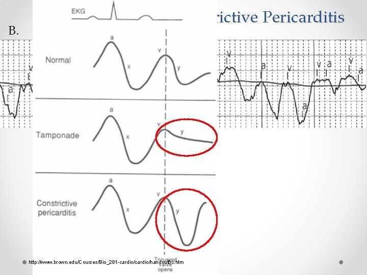 B. Tampondade vs Constrictive Pericarditis http: //www. brown. edu/Courses/Bio_281 -cardio/handout 6 c. htm 