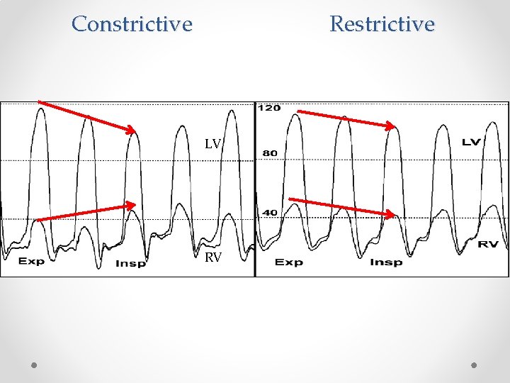 Constrictive Restrictive LV RV 