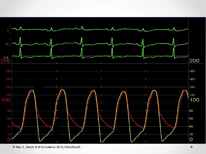Ren X , Banki N M Circulation 2012; 126: e 28 -e 29 
